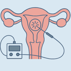 2025 | Uterine Fibroid RFA | EN